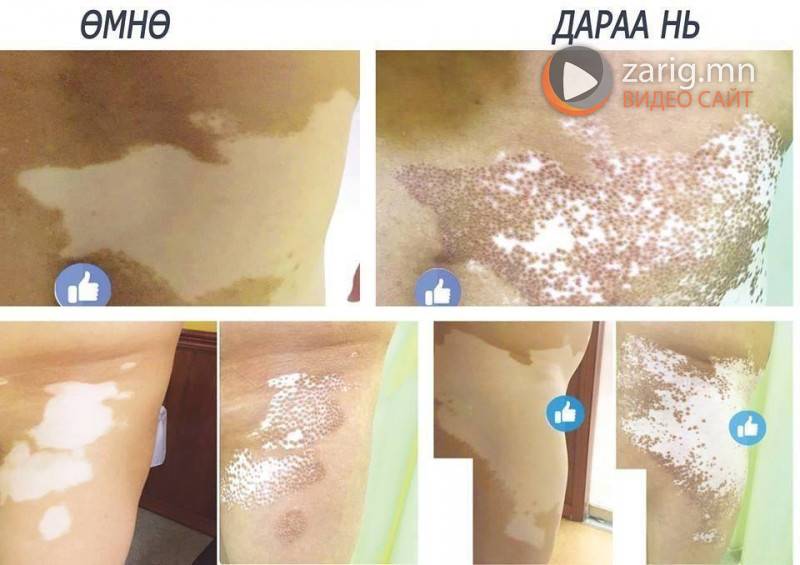 Арьс цайх өвчнийг Мон шинжүкү скин мед эмнэлэг бүрэн эмчилж байна